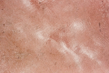 comment_soigner_eczema_naturellement